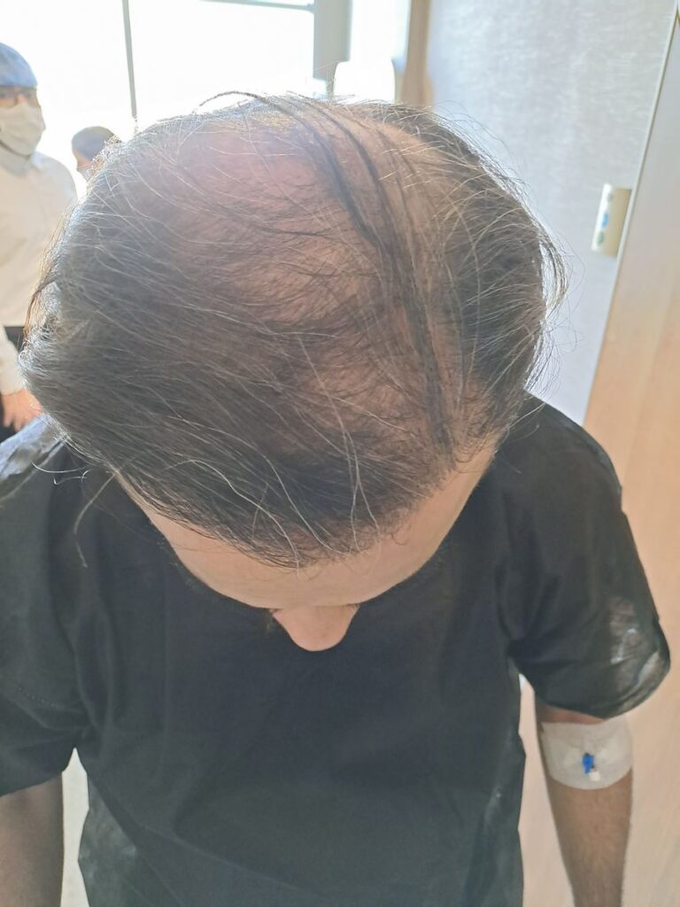 Billede 29 fra HÅRTRANSPLANTATION 2 - FEB 2023