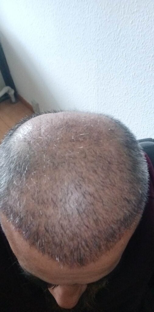 Billede 31 fra HÅRTRANSPLANTATION 2 - FEB 2023