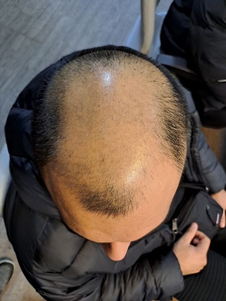 Billede 32 fra HÅRTRANSPLANTATION 2 - FEB 2023