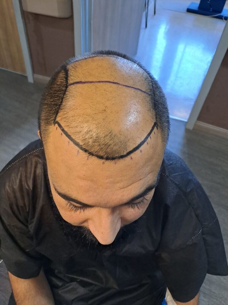 Billede 33 fra HÅRTRANSPLANTATION 2 - FEB 2023