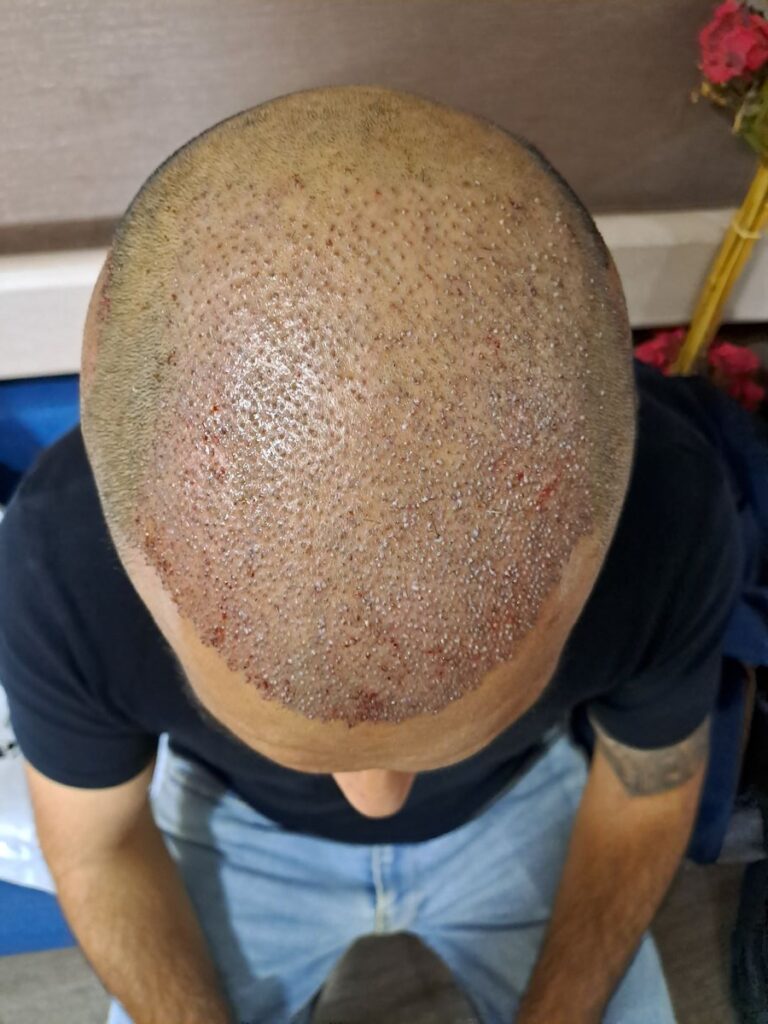 Billede 34 fra HÅRTRANSPLANTATION 2 - FEB 2023