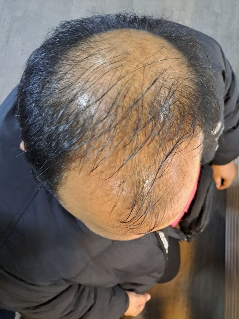 Billede 26 fra HÅRTRANSPLANTATION 2 - FEB 2023