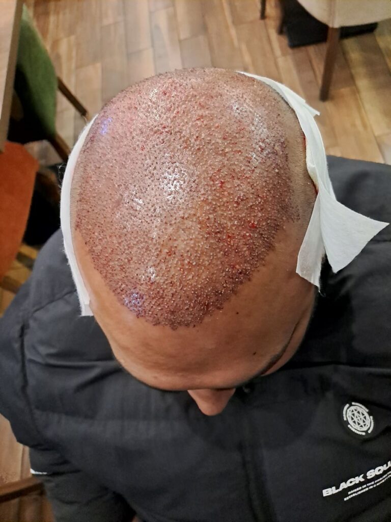 Billede 27 fra HÅRTRANSPLANTATION 2 - FEB 2023