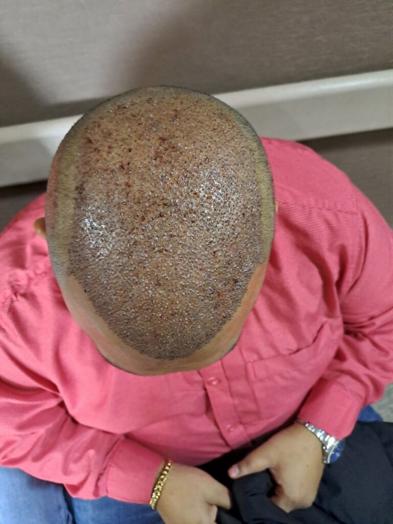 Billede 28 fra HÅRTRANSPLANTATION 2 - FEB 2023