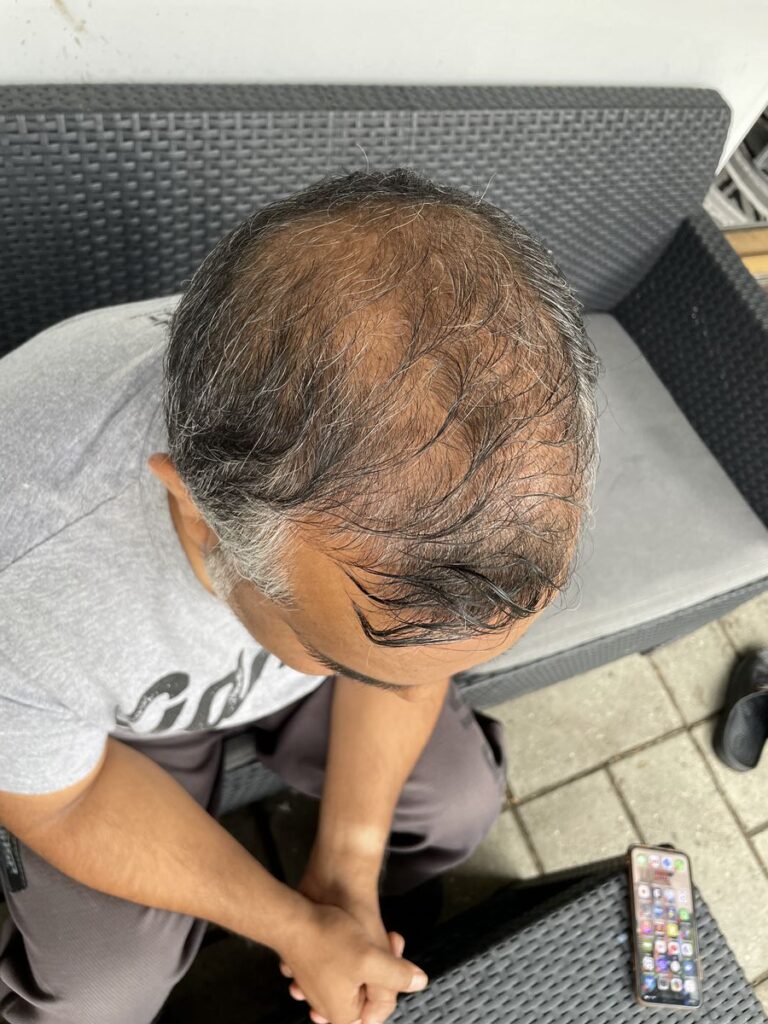Billede 1 fra HÅRTRANSPLANTATION 1 - JAN 2023