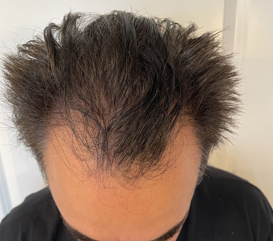Billede 4 fra HÅRTRANSPLANTATION 1 - JAN 2023