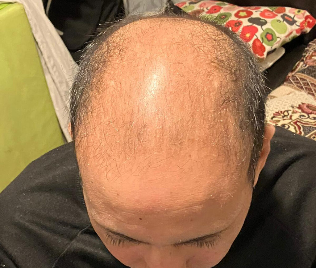 Billede 7 fra HÅRTRANSPLANTATION 1 - JAN 2023